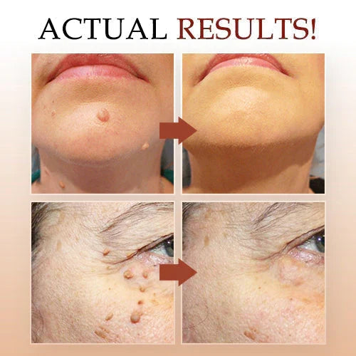 Jaysuing Liquid Wart Remover – Advanced Wart Removal Treatment for Face, Hands & Body