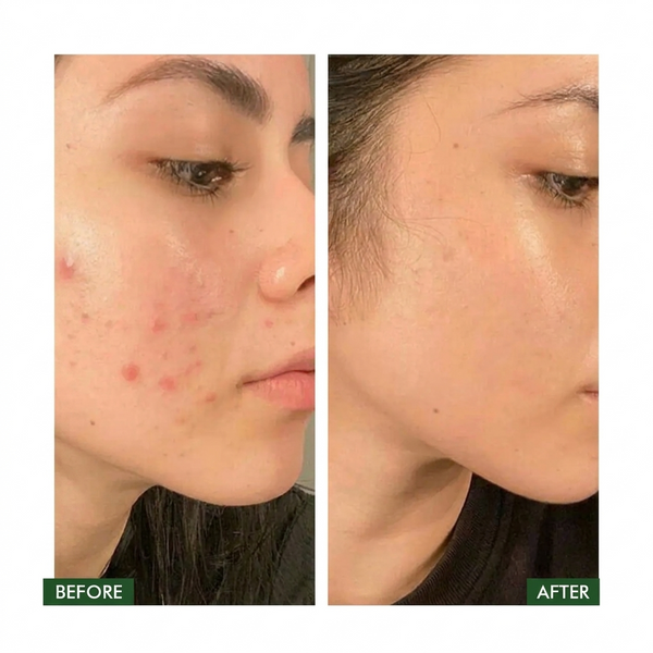Salicylic Acid Remove Acne Gel 20G, Rapid Action Acne Spot Treatment for Face Closure And Acne Dots, Premium Acne Scar Gel And Pimple Remover