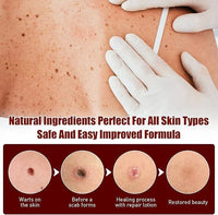 Jaysuing Liquid Wart Remover – Advanced Wart Removal Treatment for Face, Hands & Body