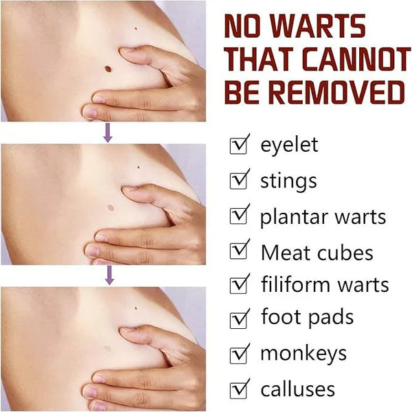 Jaysuing Liquid Wart Remover – Advanced Wart Removal Treatment for Face, Hands & Body