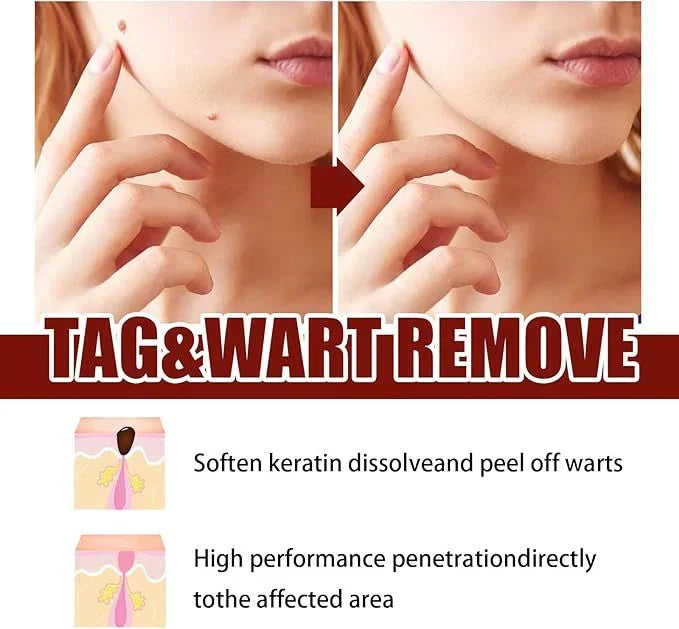 Jaysuing Liquid Wart Remover – Advanced Wart Removal Treatment for Face, Hands & Body