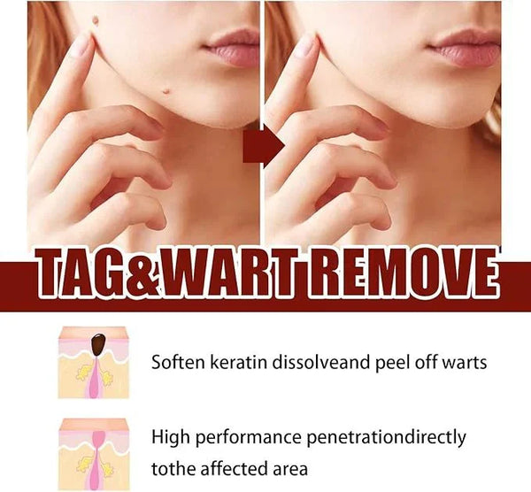 Jaysuing Liquid Wart Remover – Advanced Wart Removal Treatment for Face, Hands & Body